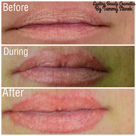 Lip tattoo removal near me